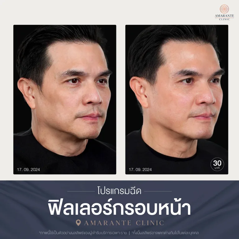 โปรแกรมฉีดฟิลเลอร์กรอบหน้า-04
