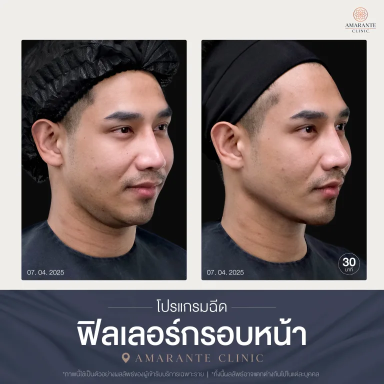 โปรแกรมฉีดฟิลเลอร์กรอบหน้า-05
