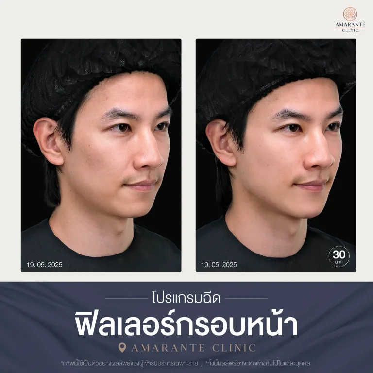 โปรแกรมฉีดฟิลเลอร์กรอบหน้า-06