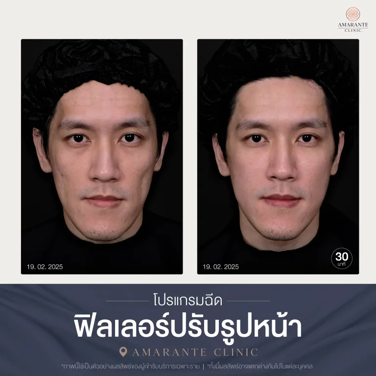 โปรแกรมฉีดฟิลเลอร์ปรับรูปหน้า-03