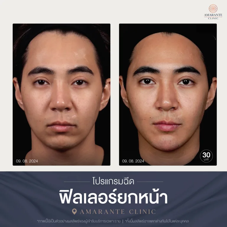 โปรแกรมฉีดฟิลเลอร์ยกหน้า-03