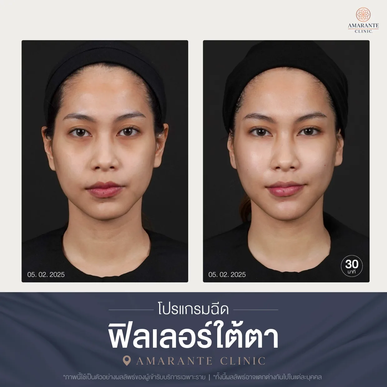 โปรแกรมฉีดฟิลเลอร์ใต้ตา-01