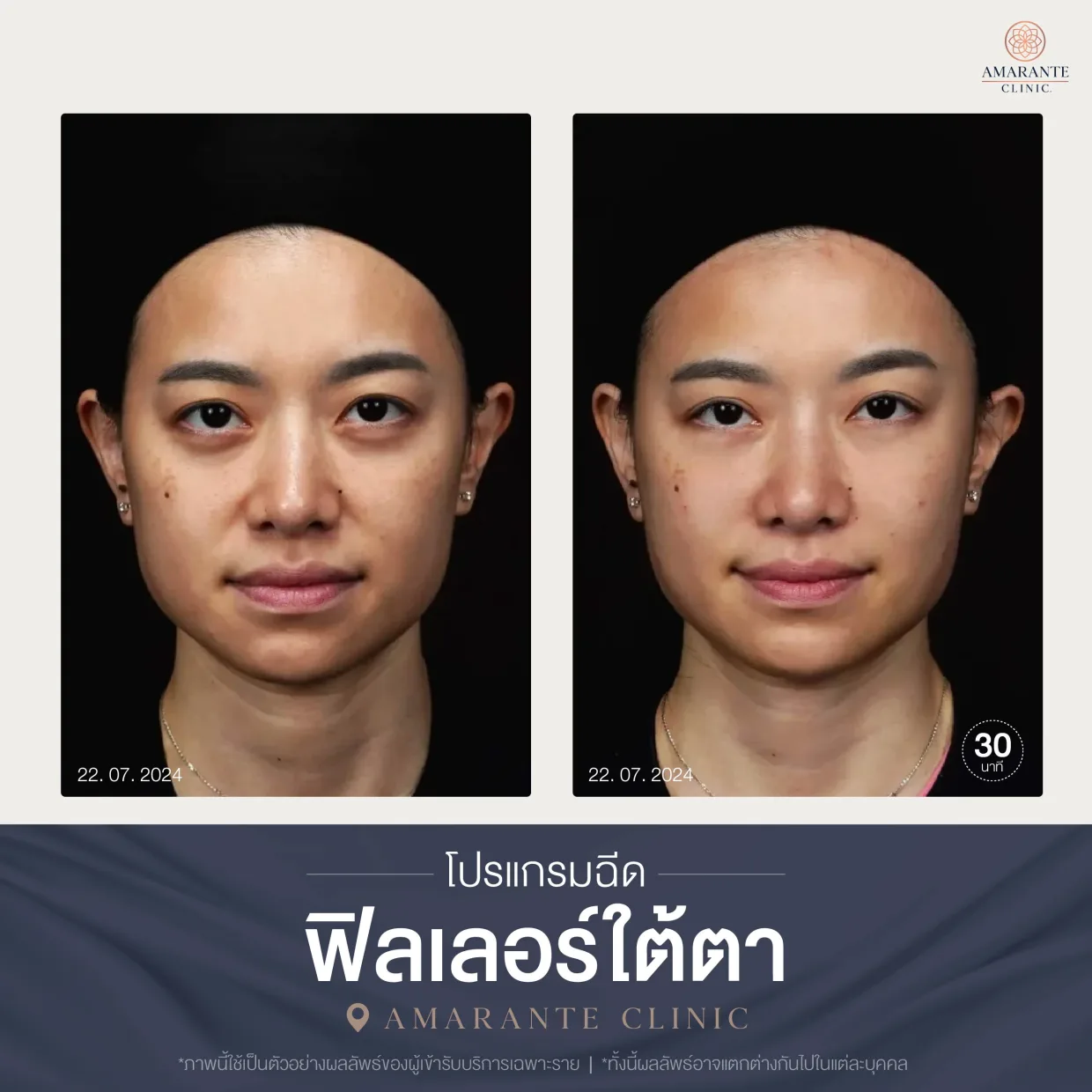 โปรแกรมฉีดฟิลเลอร์ใต้ตา-02