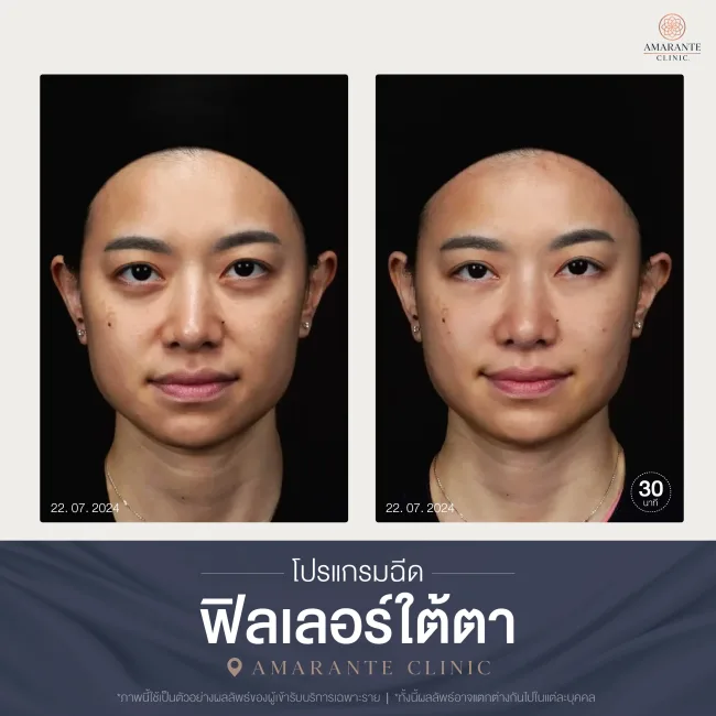 โปรแกรมฉีดฟิลเลอร์ใต้ตา-02