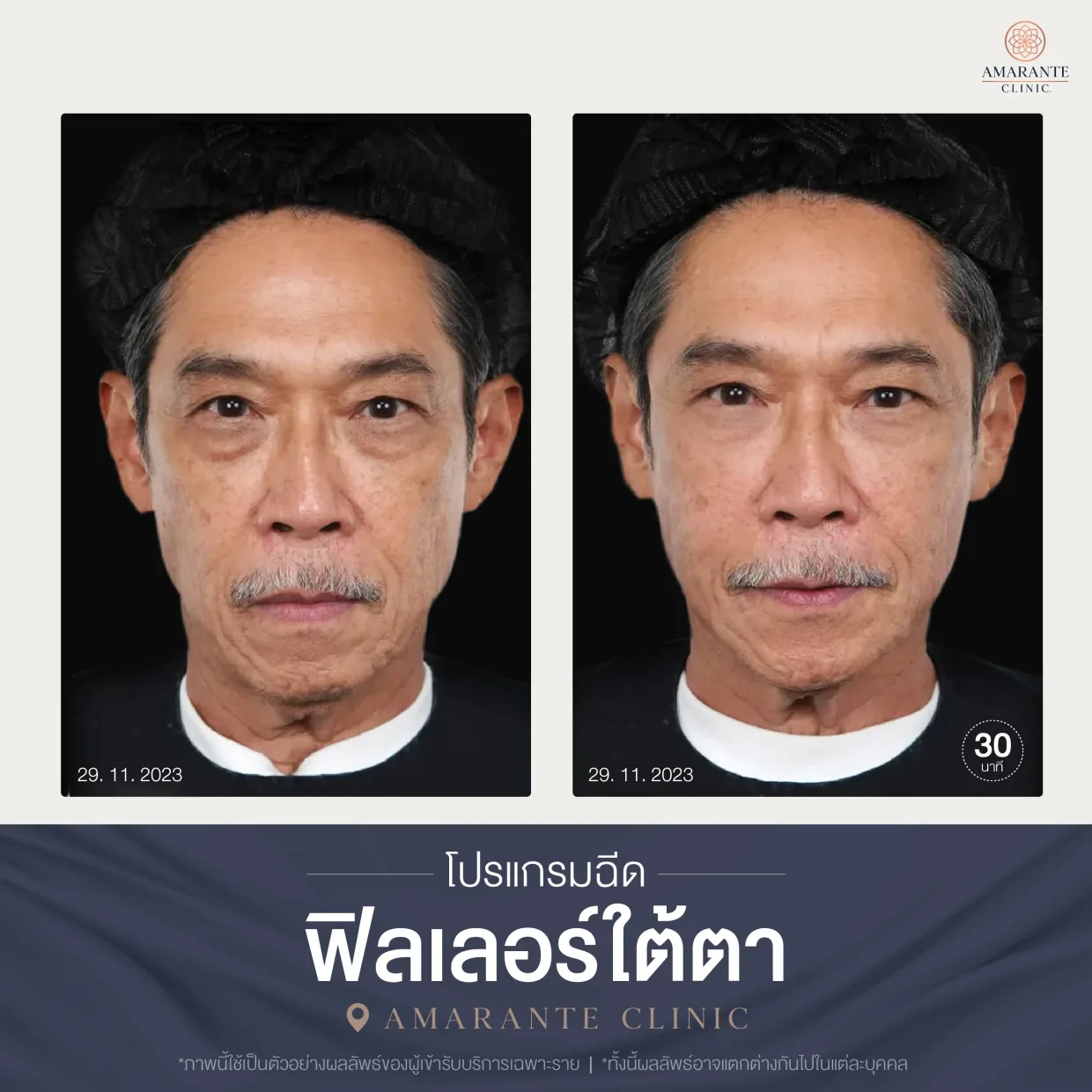 โปรแกรมฉีดฟิลเลอร์ใต้ตา-03