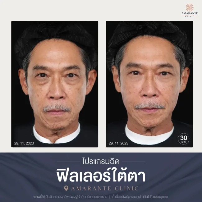 โปรแกรมฉีดฟิลเลอร์ใต้ตา-03