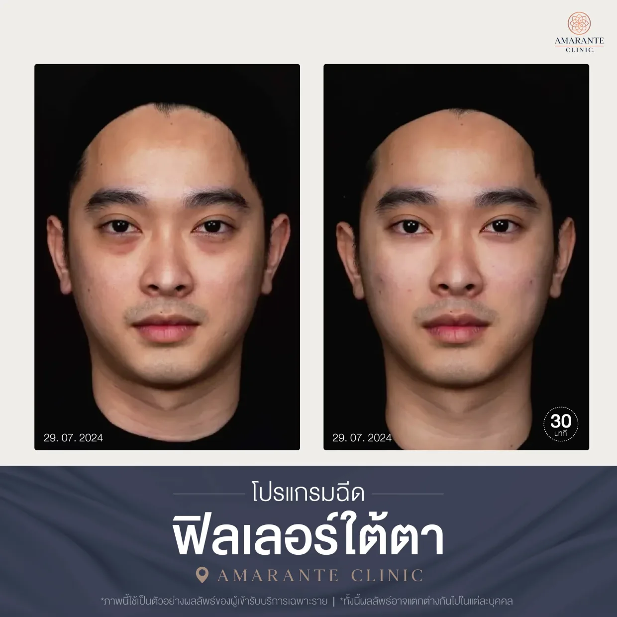 โปรแกรมฉีดฟิลเลอร์ใต้ตา-04