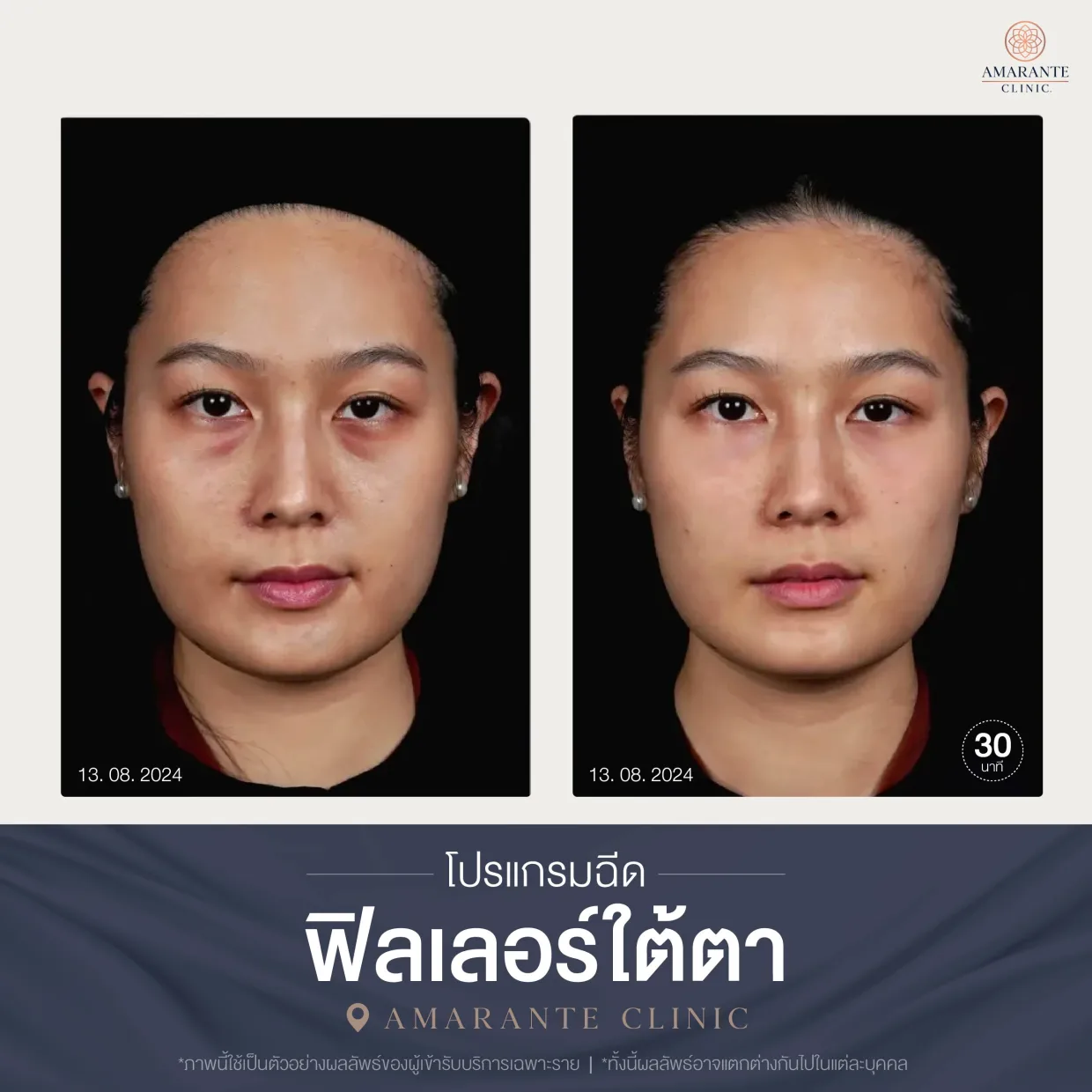 โปรแกรมฉีดฟิลเลอร์ใต้ตา-05