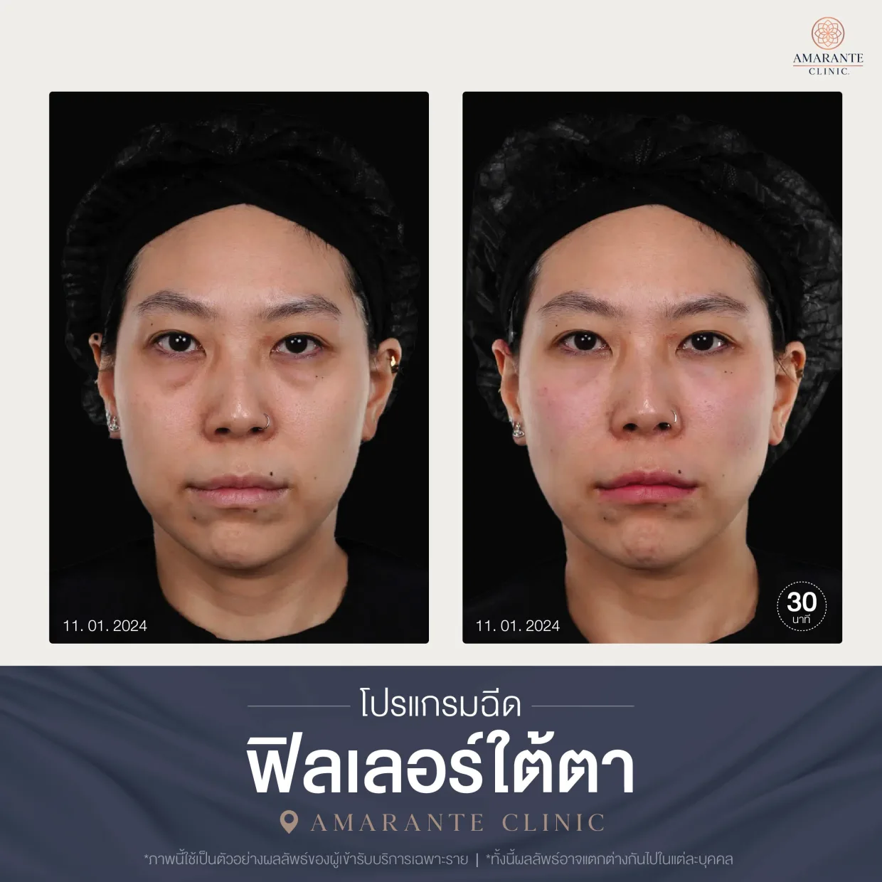 โปรแกรมฉีดฟิลเลอร์ใต้ตา-06