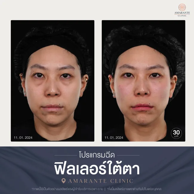 โปรแกรมฉีดฟิลเลอร์ใต้ตา-06