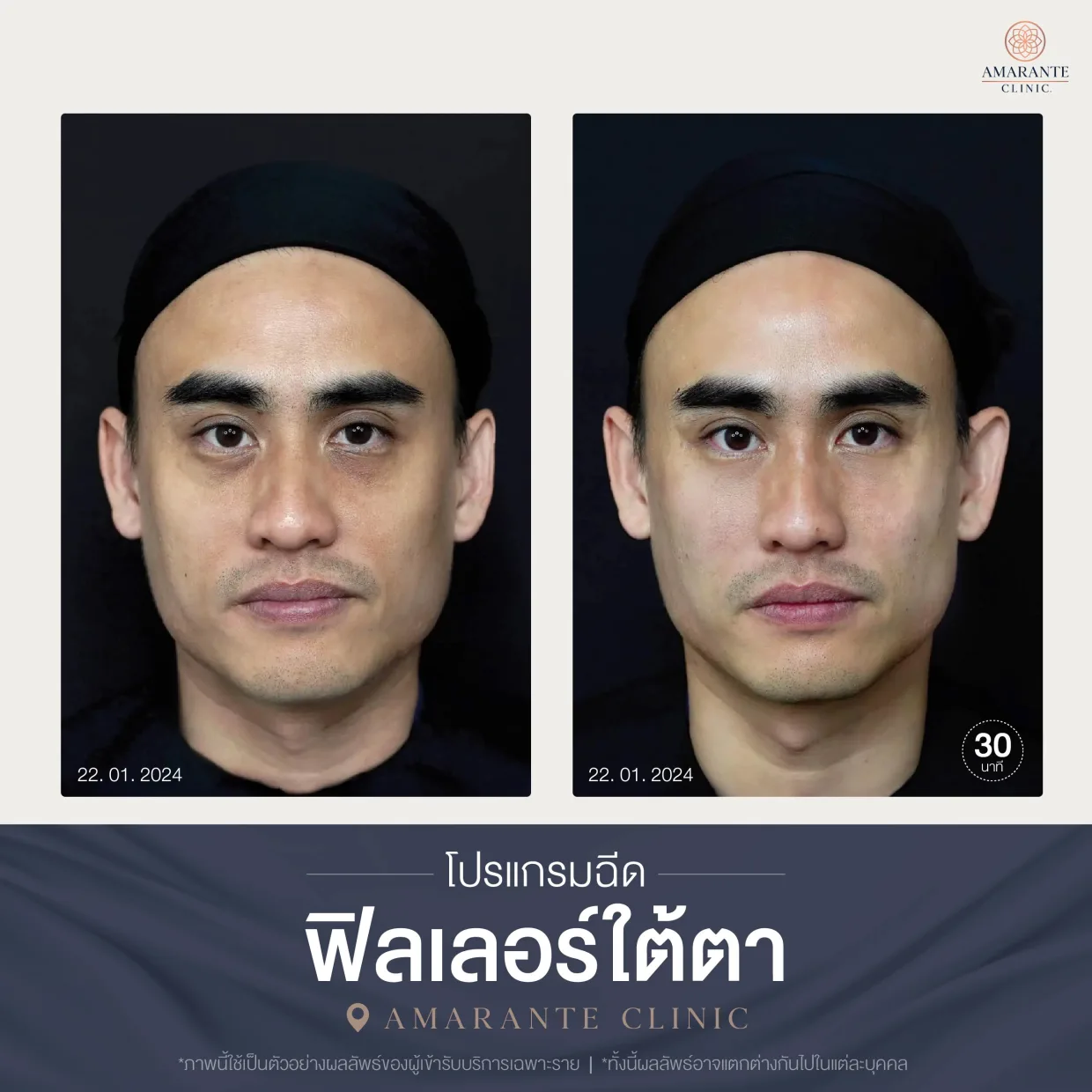 โปรแกรมฉีดฟิลเลอร์ใต้ตา-07