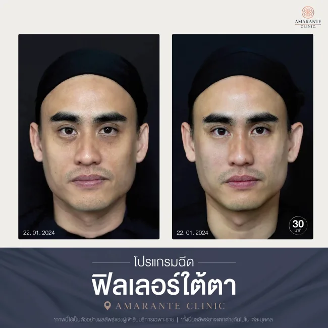 โปรแกรมฉีดฟิลเลอร์ใต้ตา-07
