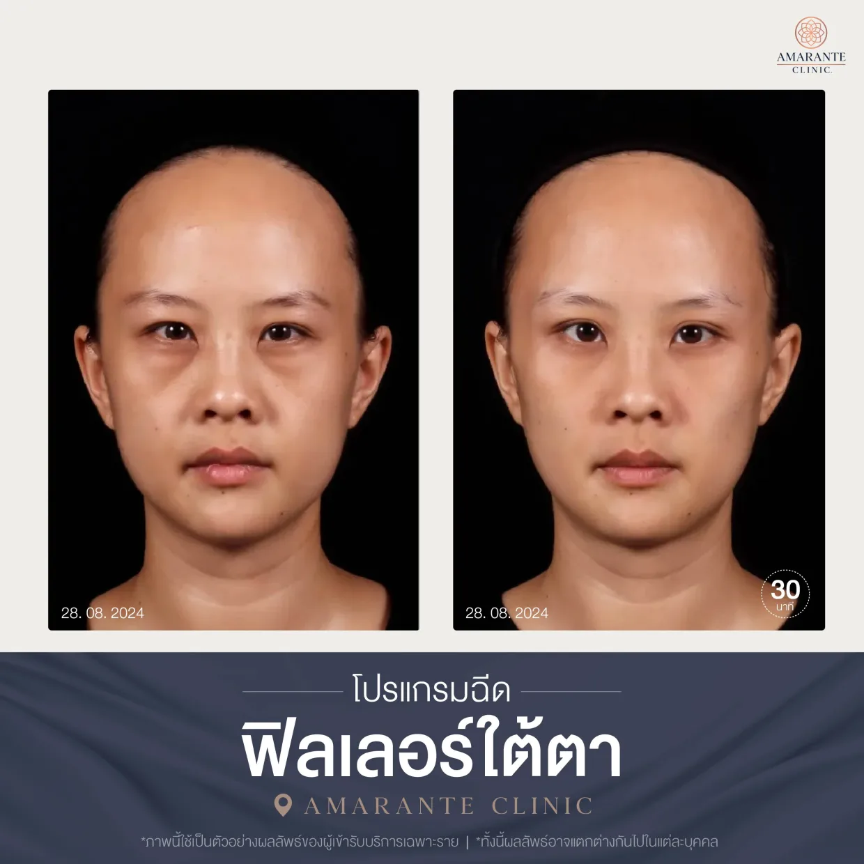 โปรแกรมฉีดฟิลเลอร์ใต้ตา-08