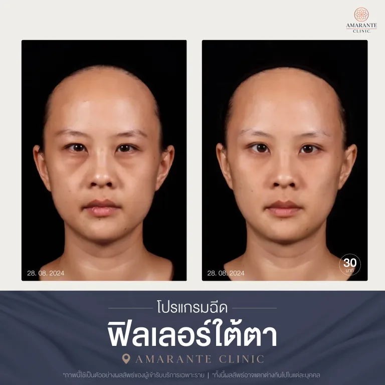 โปรแกรมฉีดฟิลเลอร์ใต้ตา-08