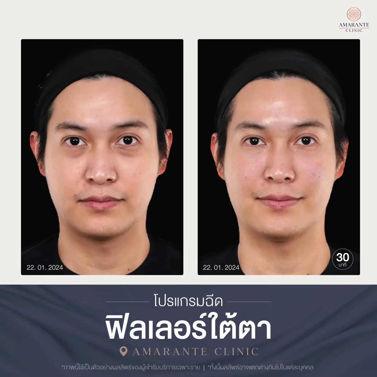 โปรแกรมฉีดฟิลเลอร์ใต้ตา-09