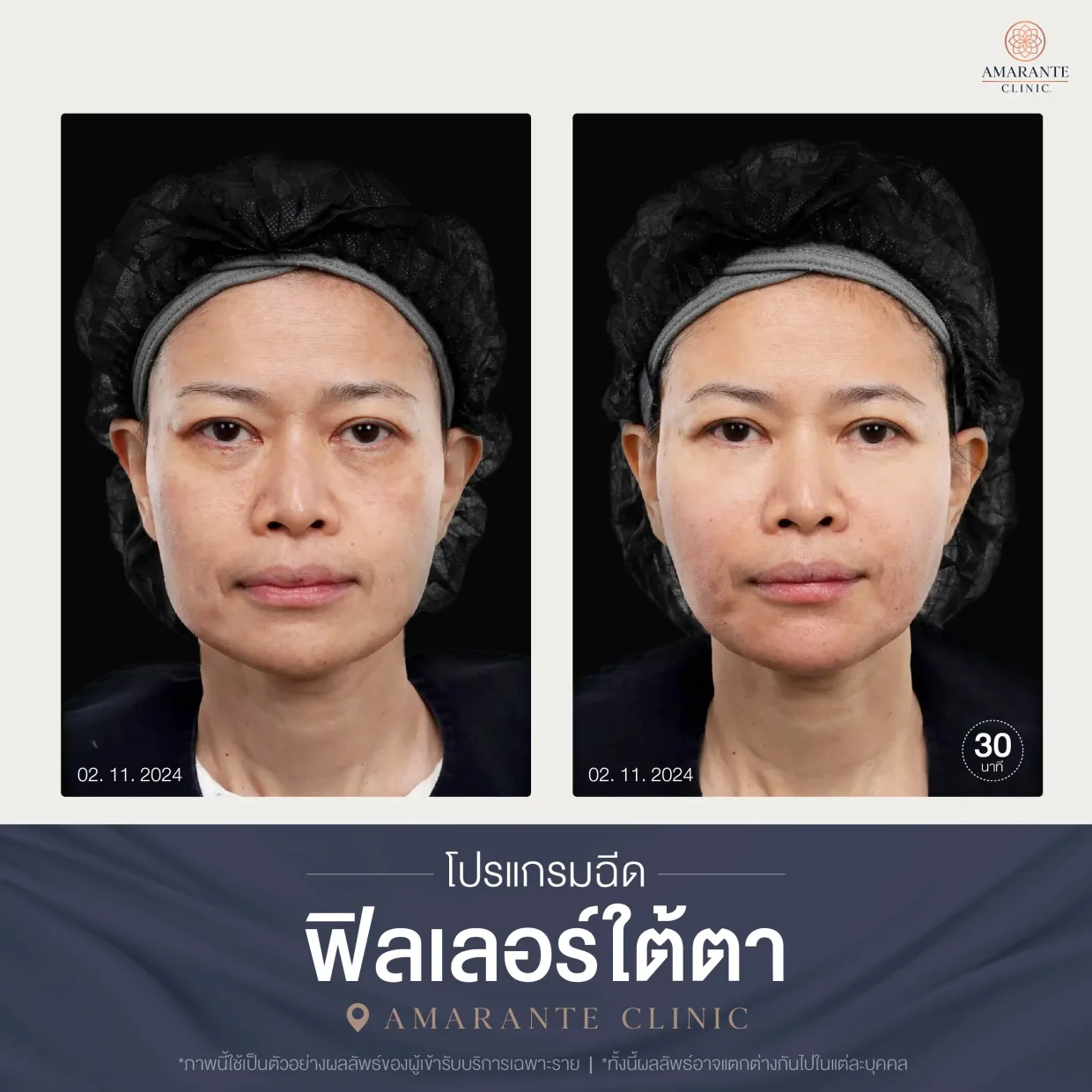 โปรแกรมฉีดฟิลเลอร์ใต้ตา-10