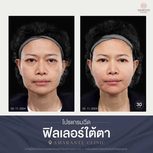 โปรแกรมฉีดฟิลเลอร์ใต้ตา-10
