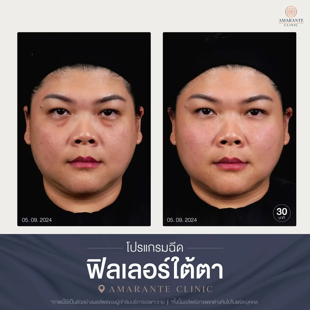 โปรแกรมฉีดฟิลเลอร์ใต้ตา-11