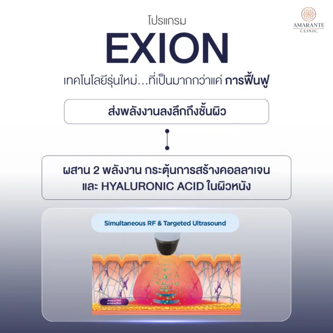 Exion กระตุ้นฟิลเลอร์ได้อย่างไร