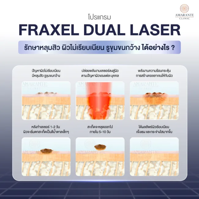 Fraxel Dual Laser รักษาหลุมสิว ผิวไม่เรียบเนียน รูขุมขนกว้างได้อย่างไร