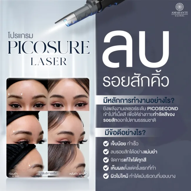 Pico Laser ช่วยลบรอยสักคิ้วได้อย่างไร ช่วยแก้ปัญหาเรื่องอะไร