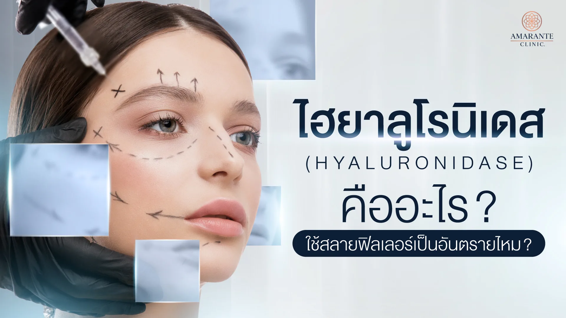 ใช้ ไฮยาลูโรนิเดส (Hyaluronidase) สลายฟิลเลอร์คืออะไร