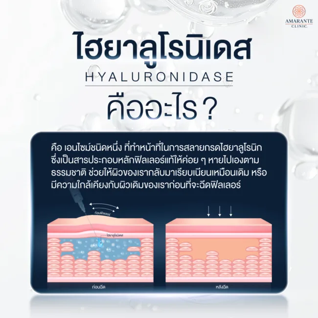 ไฮยาลูโรนิเดส (Hyaluronidase) คืออะไร