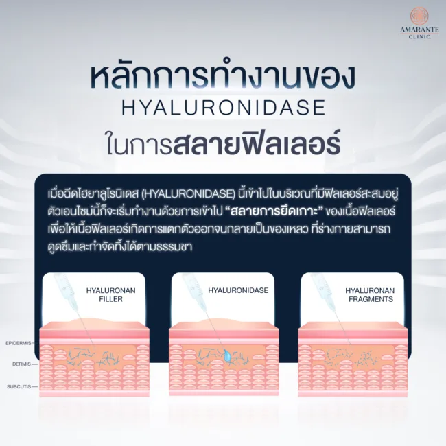 ไฮยาลูโรนิเดส (Hyaluronidase) ทำงานอย่างไร