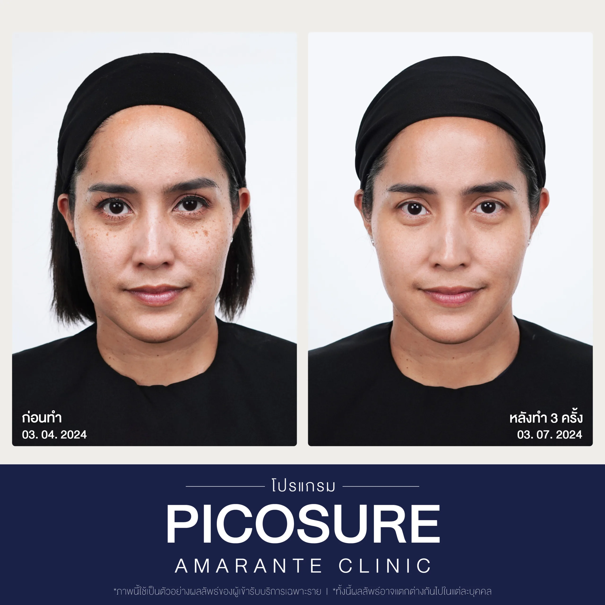 BA Picosure -02