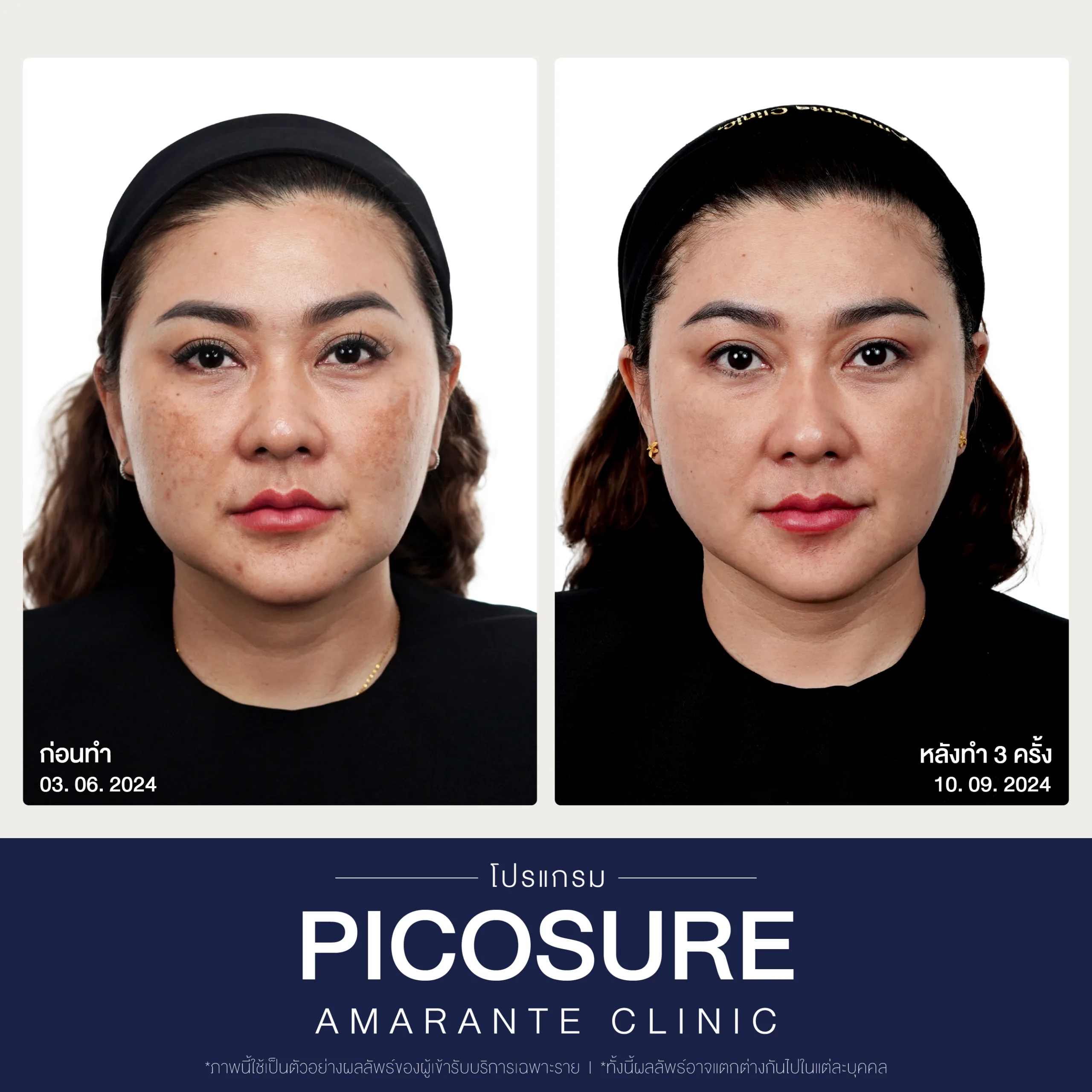 BA Picosure -06