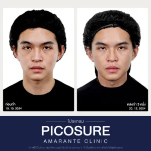 รีวิวก่อนหลังทำPico Laser3
