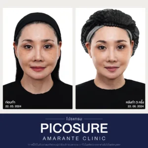 รีวิวก่อนหลังทำPico Laser