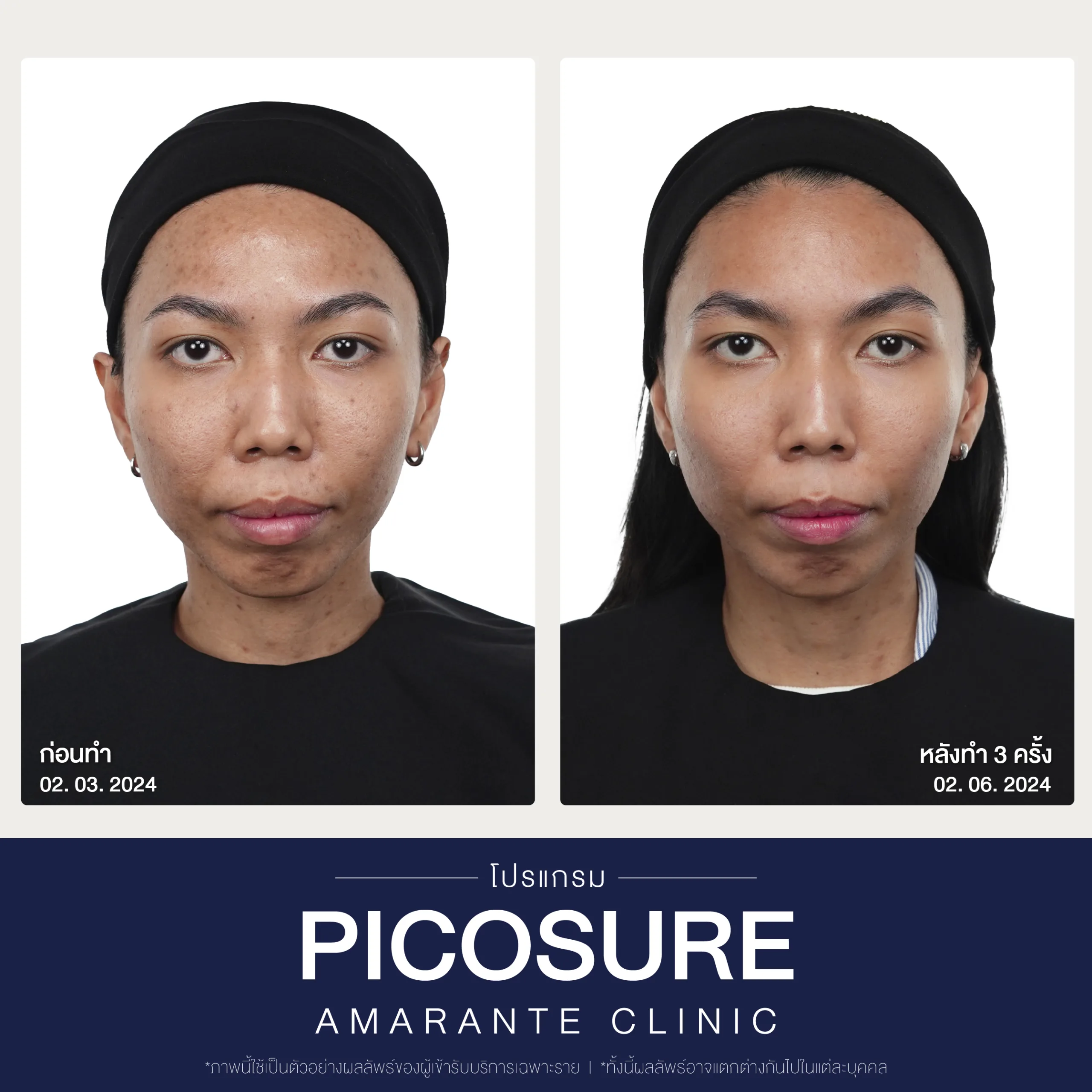 BA Picosure -09