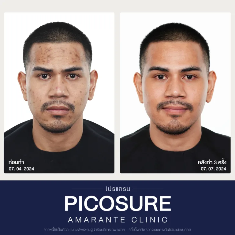 รีวิวก่อนหลังทำPico Laser1