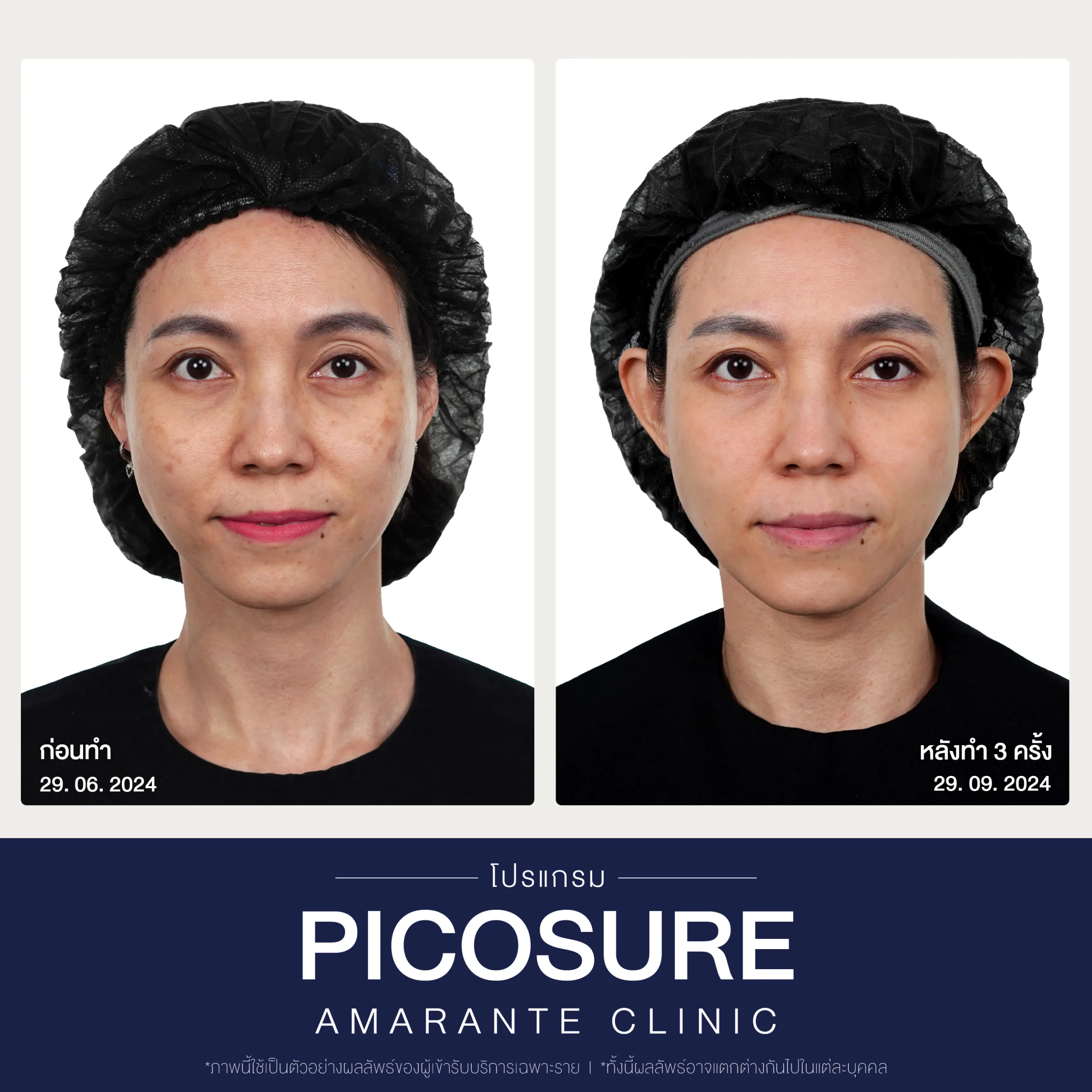 BA Picosure -12