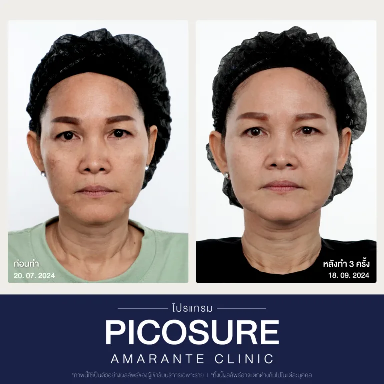 BA Picosure -19