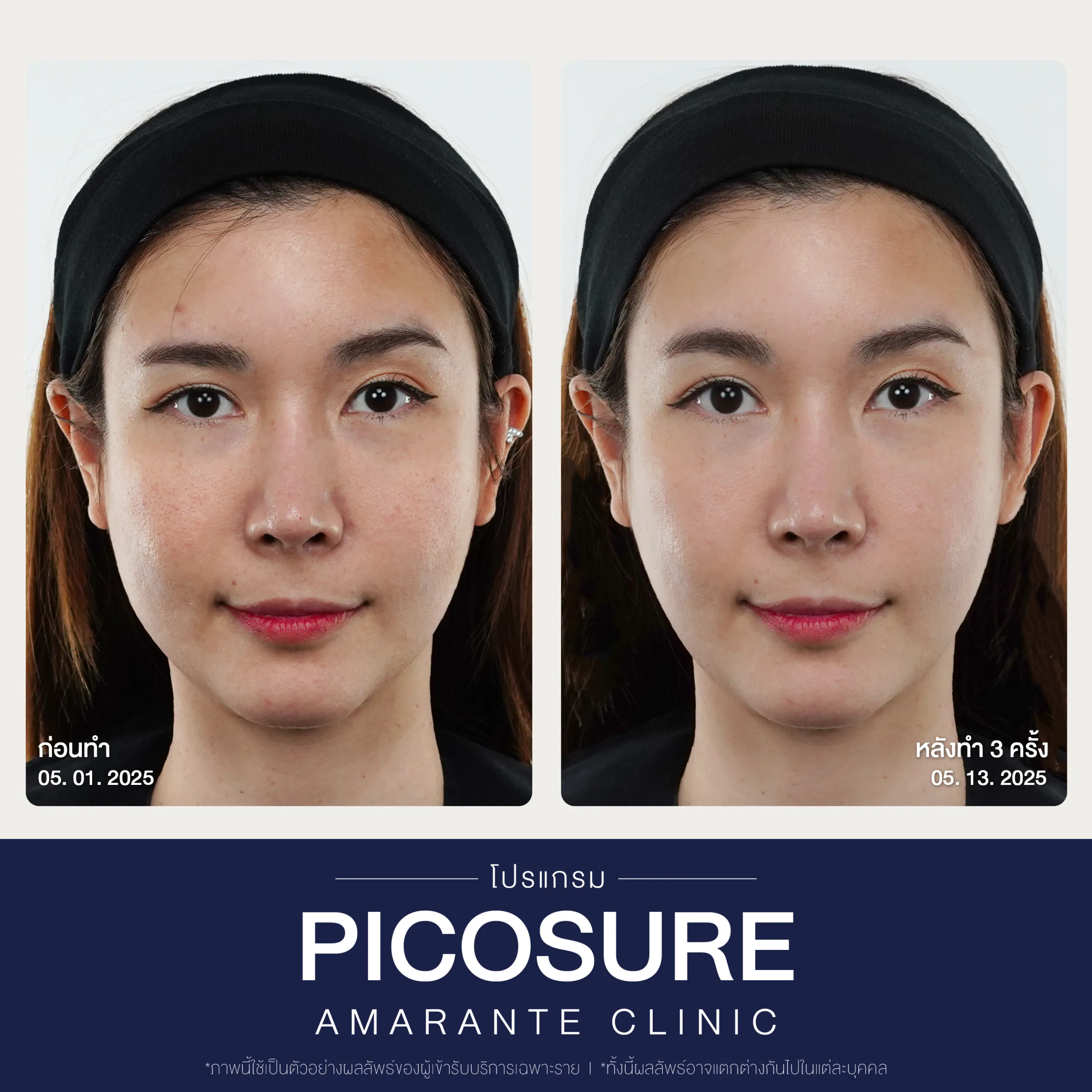 BA Picosure -21
