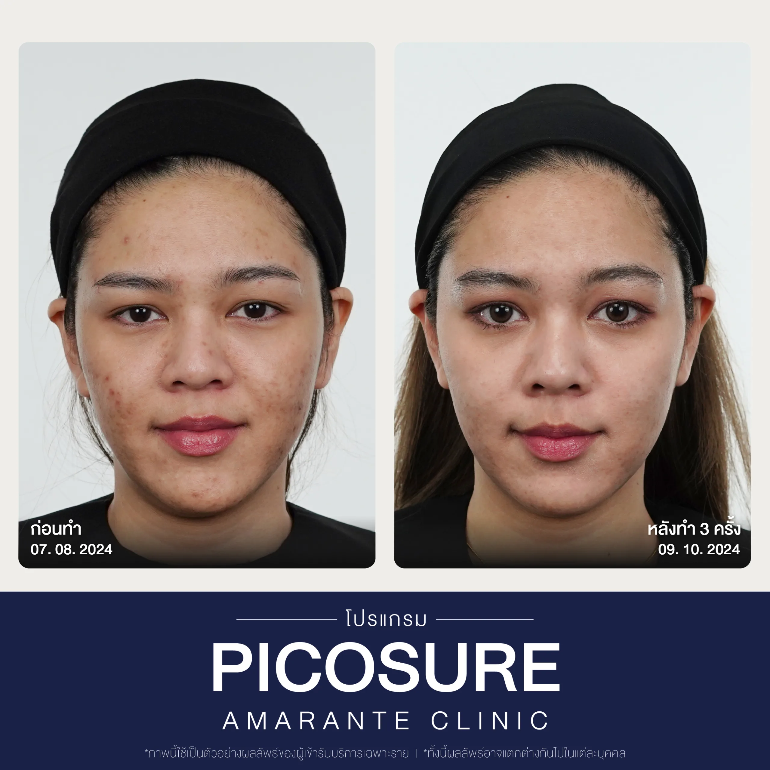 BA Picosure -27