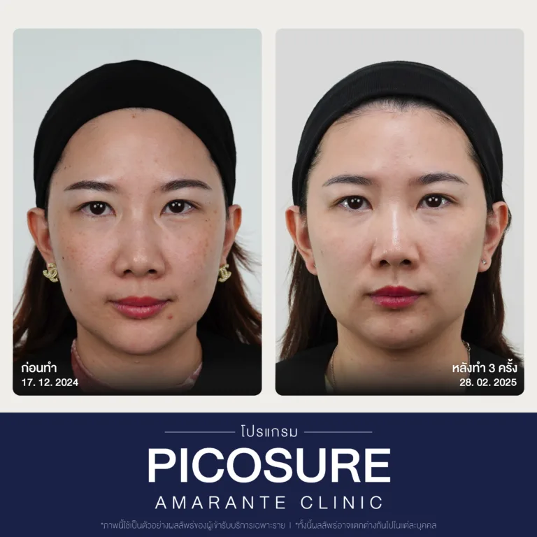 BA Picosure -29