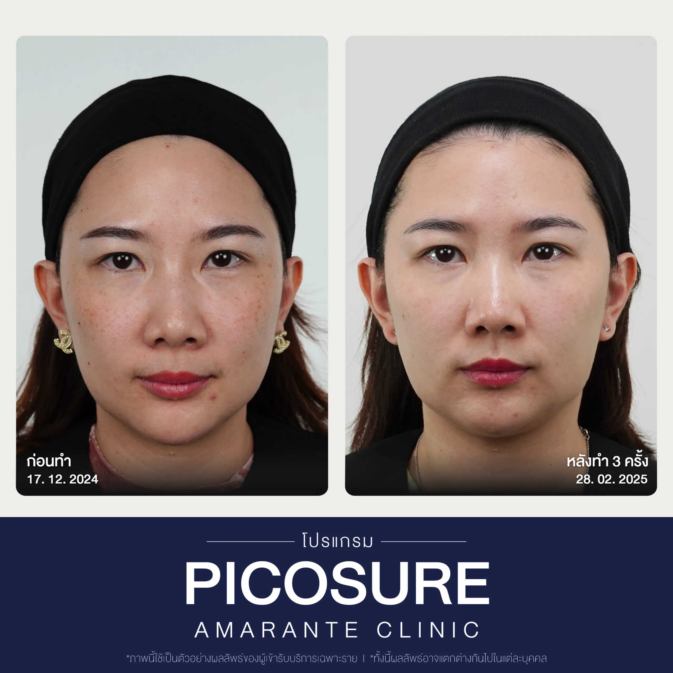 BA Picosure -29