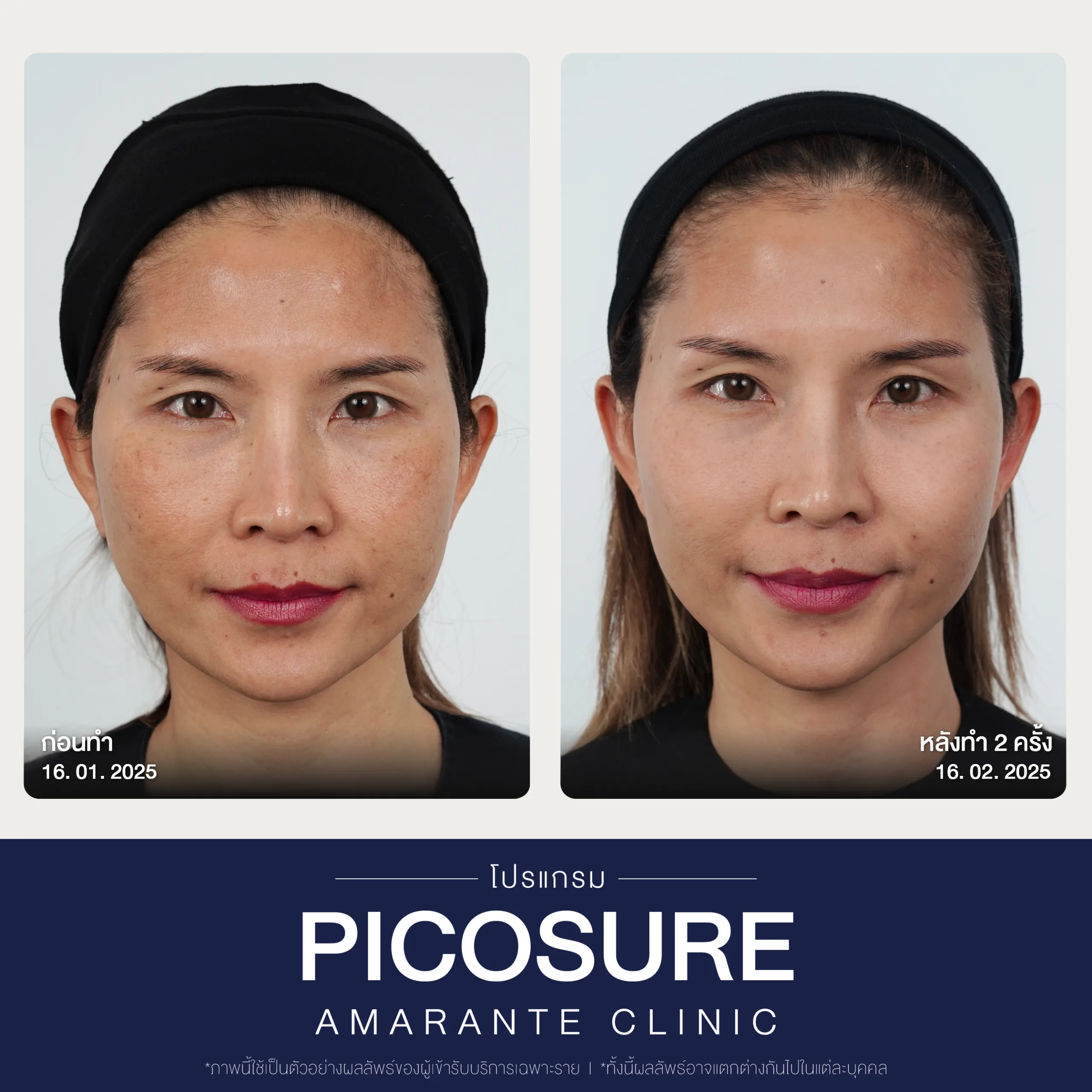 BA Picosure -32