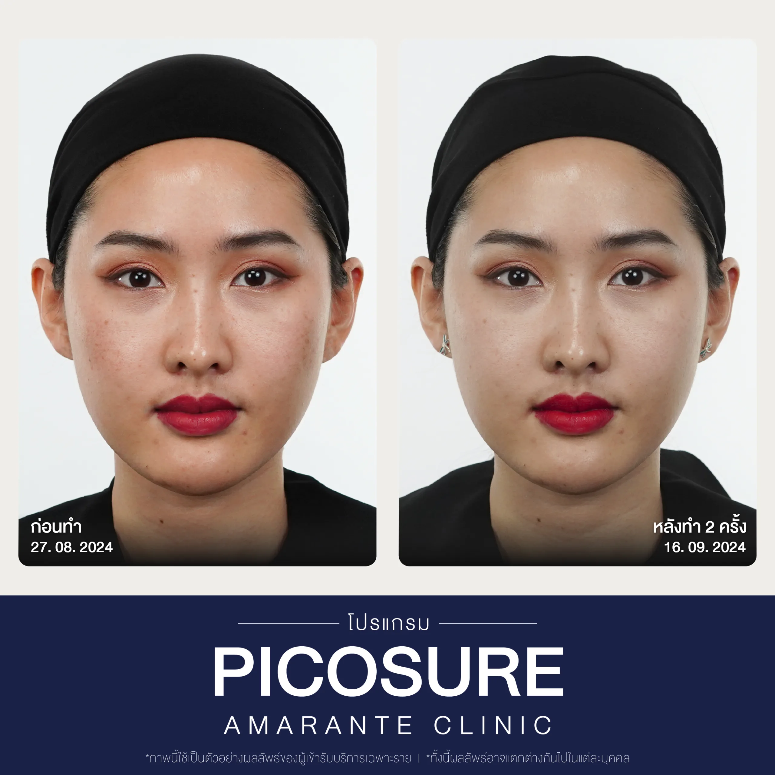 BA Picosure -33