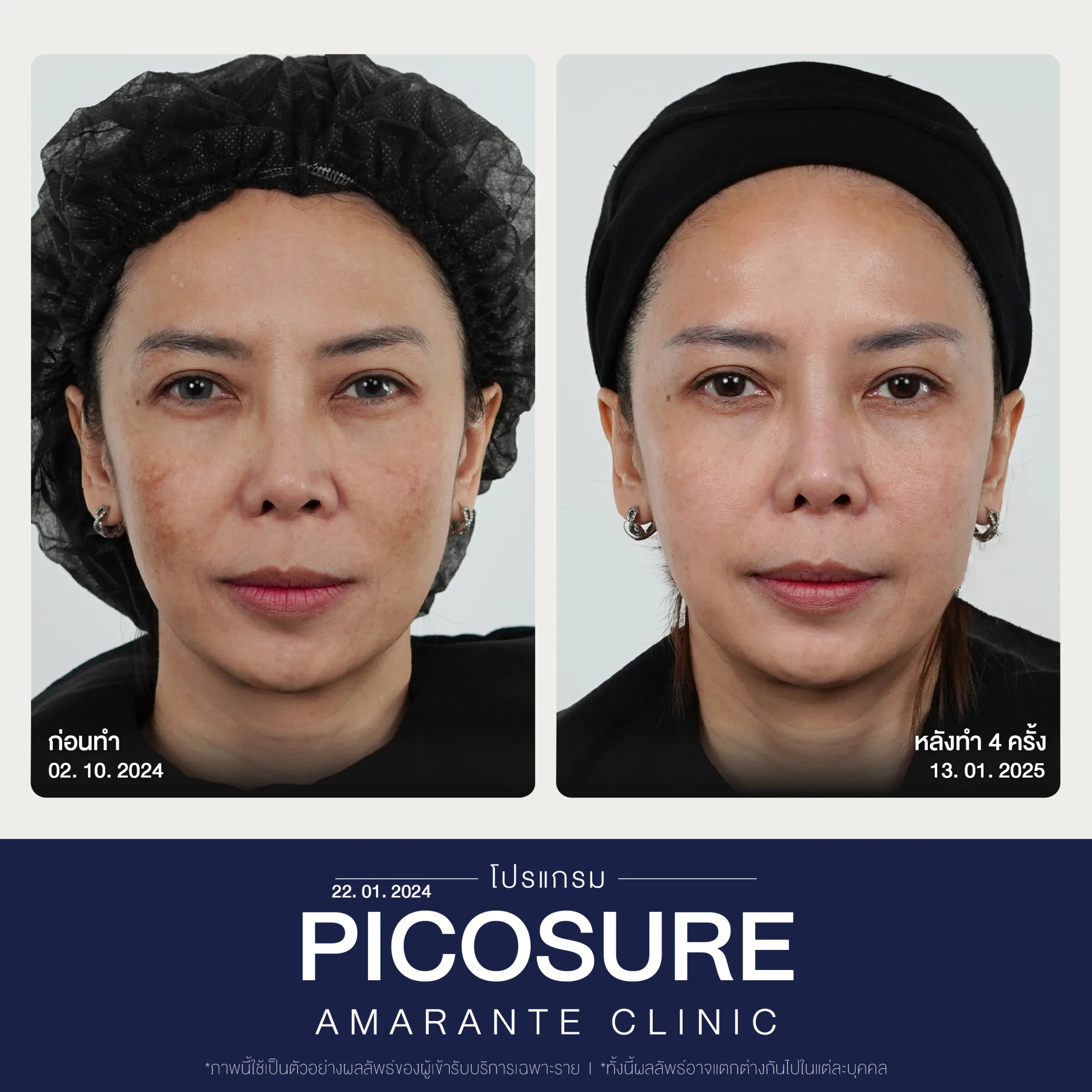 BA Picosure -34