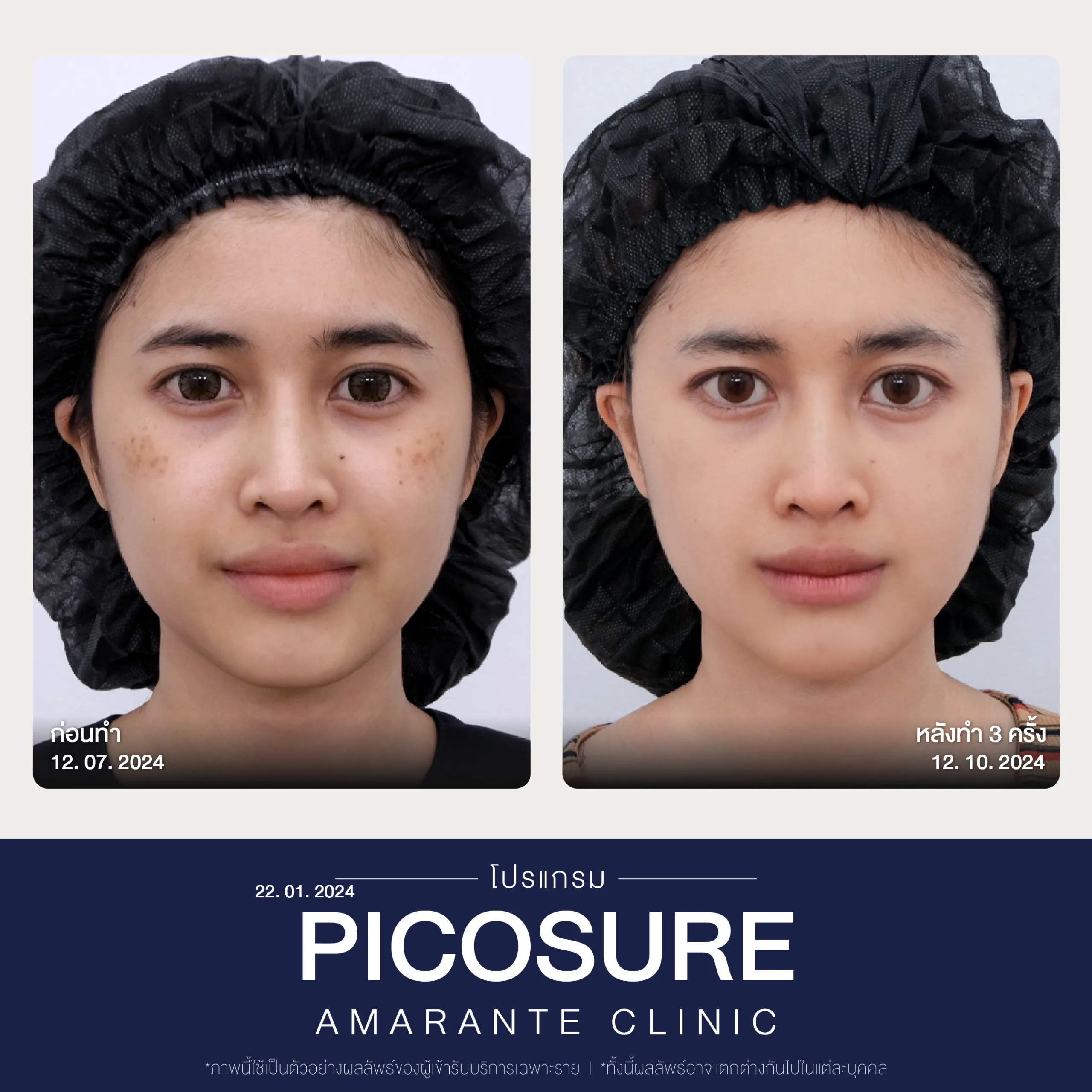 BA Picosure -55