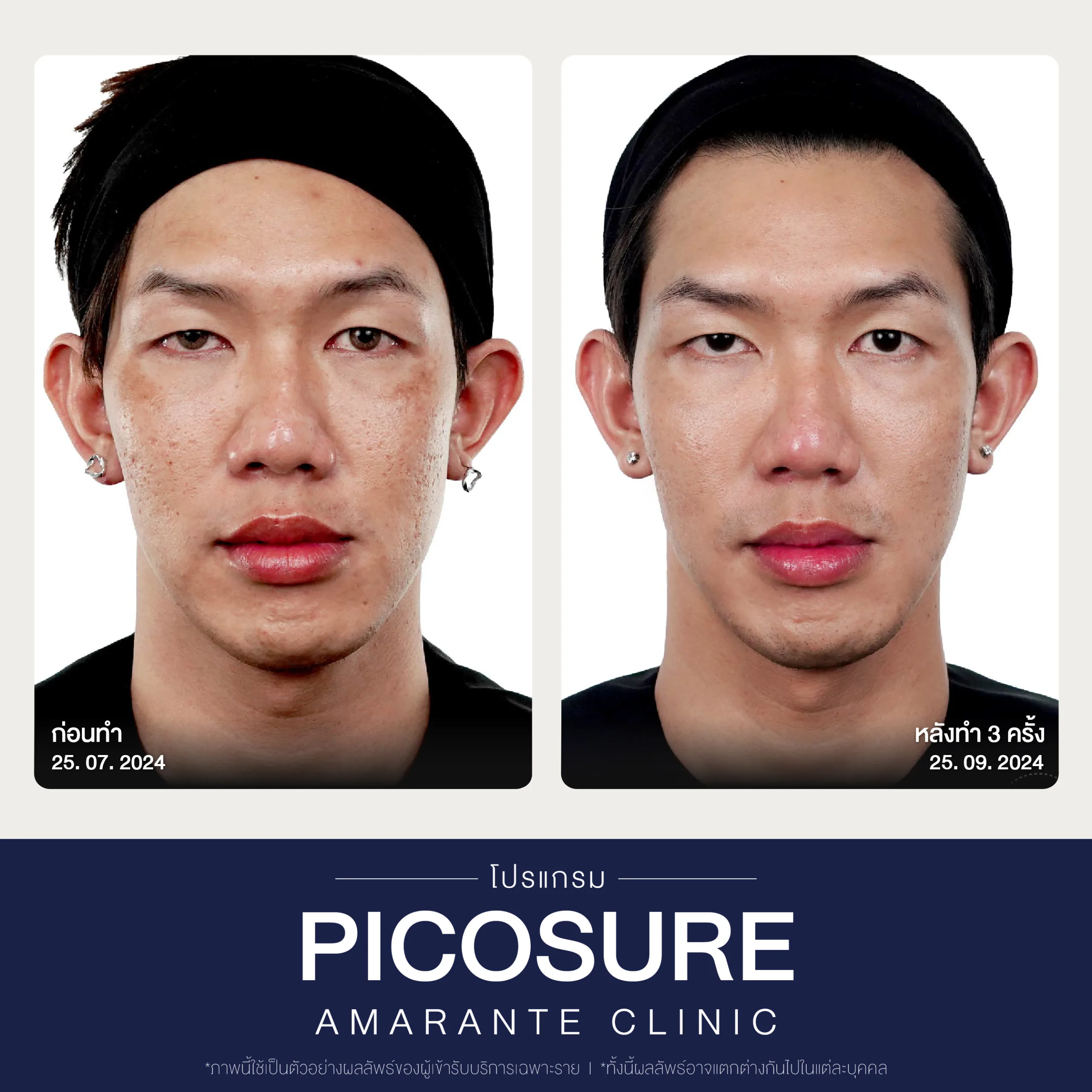 BA Picosure -73