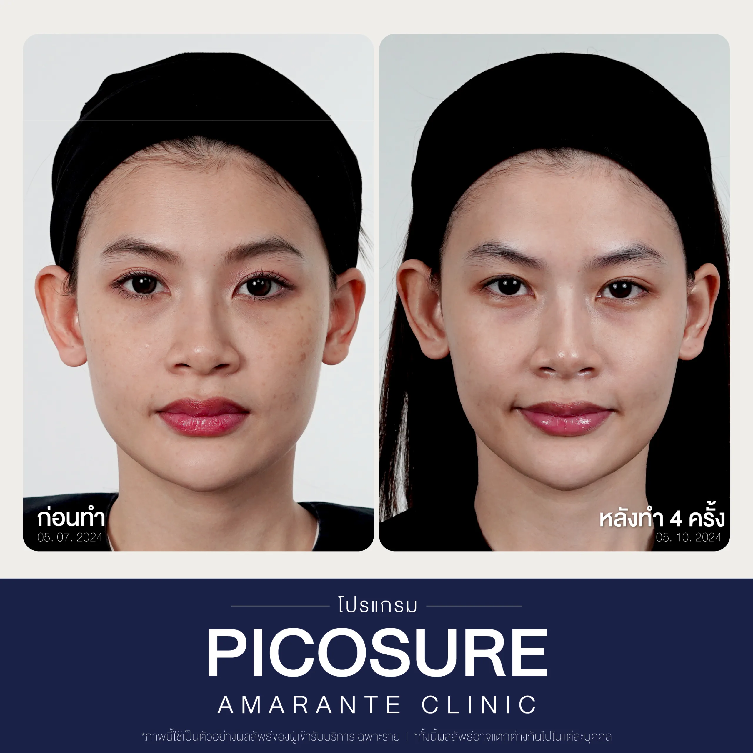 BA Picosure -77