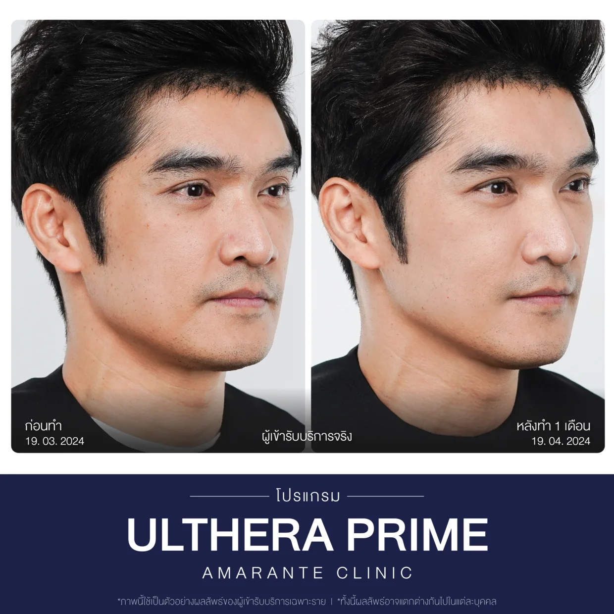 รีวิวก่อน-หลังทำUltherapy-2
