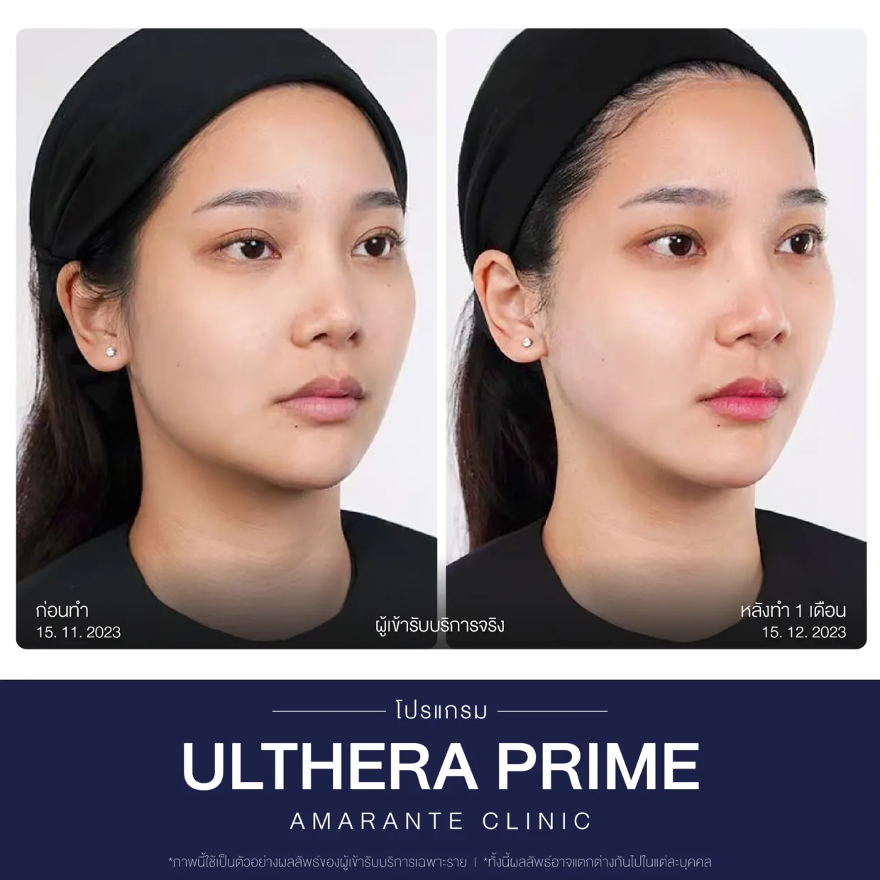 รีวิวก่อน-หลังทำUltherapy-3
