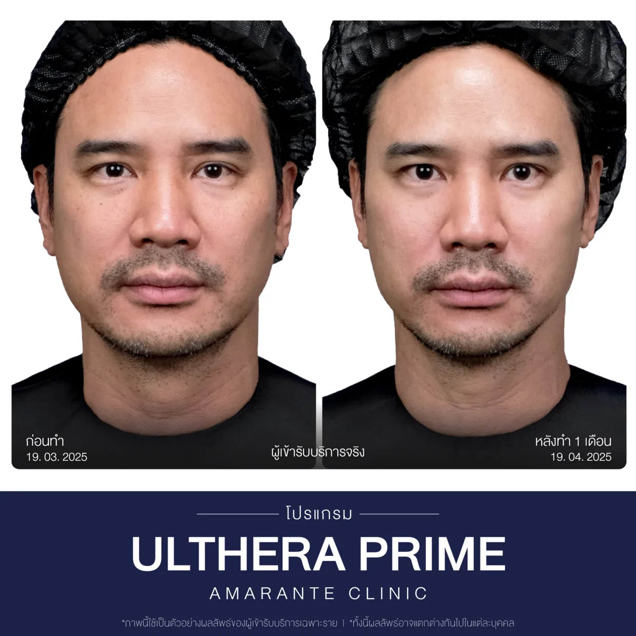 รีวิวก่อน-หลังทำUltherapy