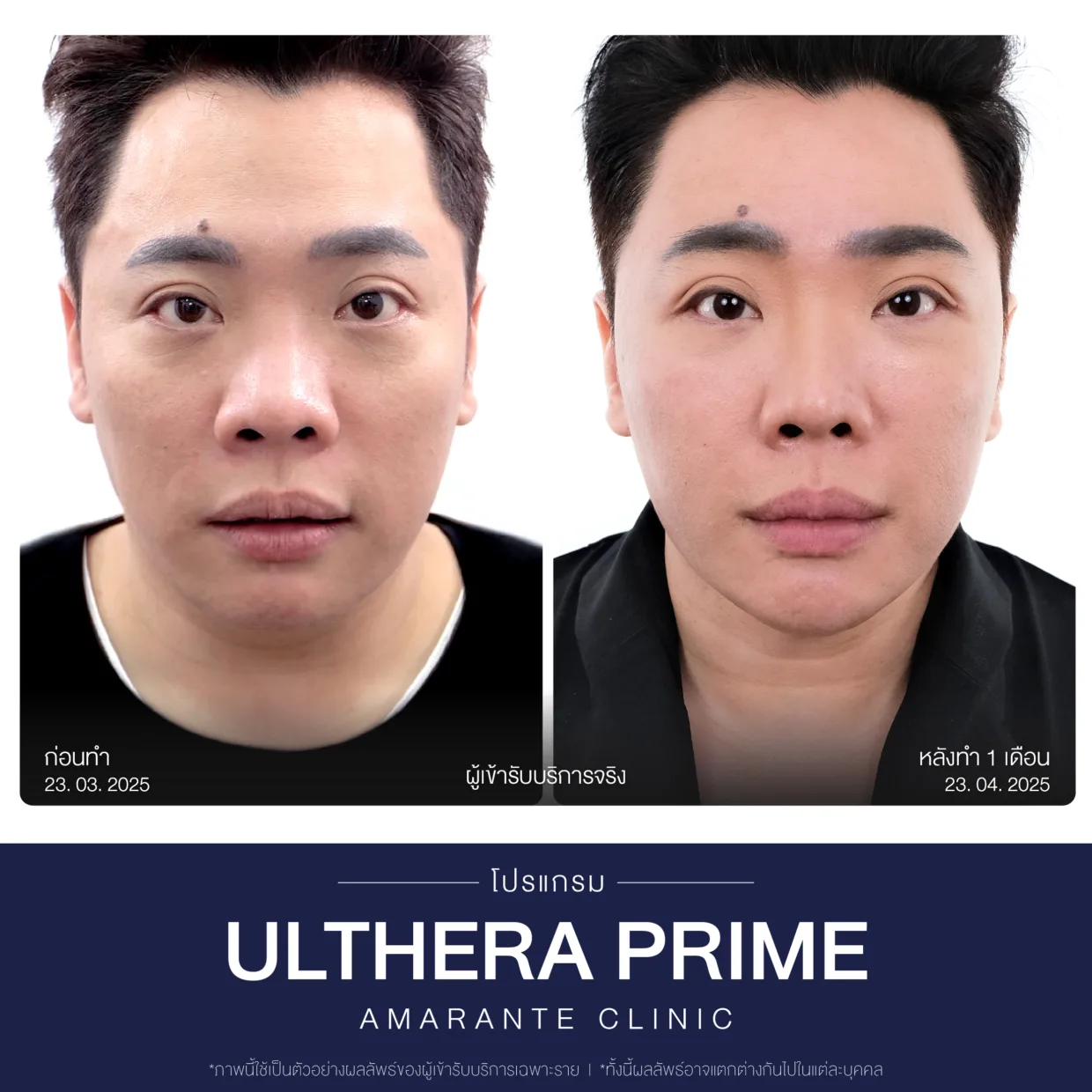 รีวิวก่อน-หลังทำUltherapyข-1